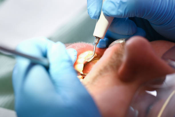 Best Emergency Tooth Extraction in Liberty, IN